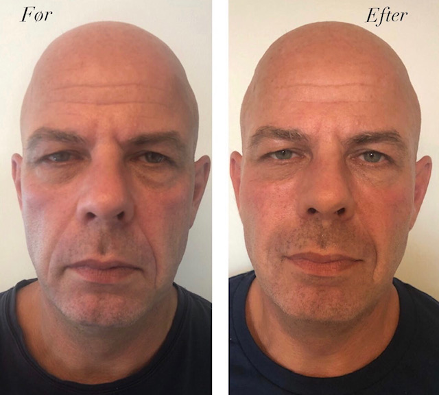 Ann-Sigts behandlinger, specielt for mænd